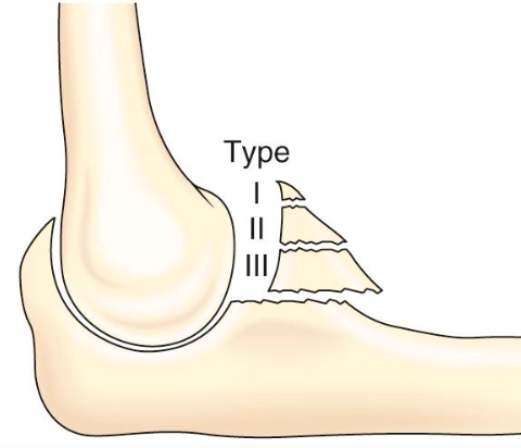 Gãy mỏm vẹt (Coronoid Fracture)