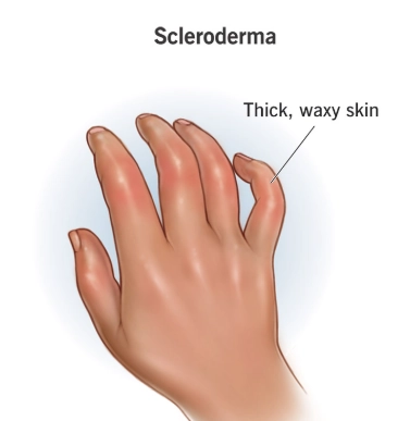 Thực quản xơ cứng bì (Scleroderma gastrointestinal manifestations)