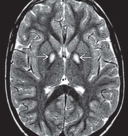 Thoái hóa thần kinh liên quan đến Pantothenate Kinase (Pantothenate kinase-associated neurodegeneration - PKAN)