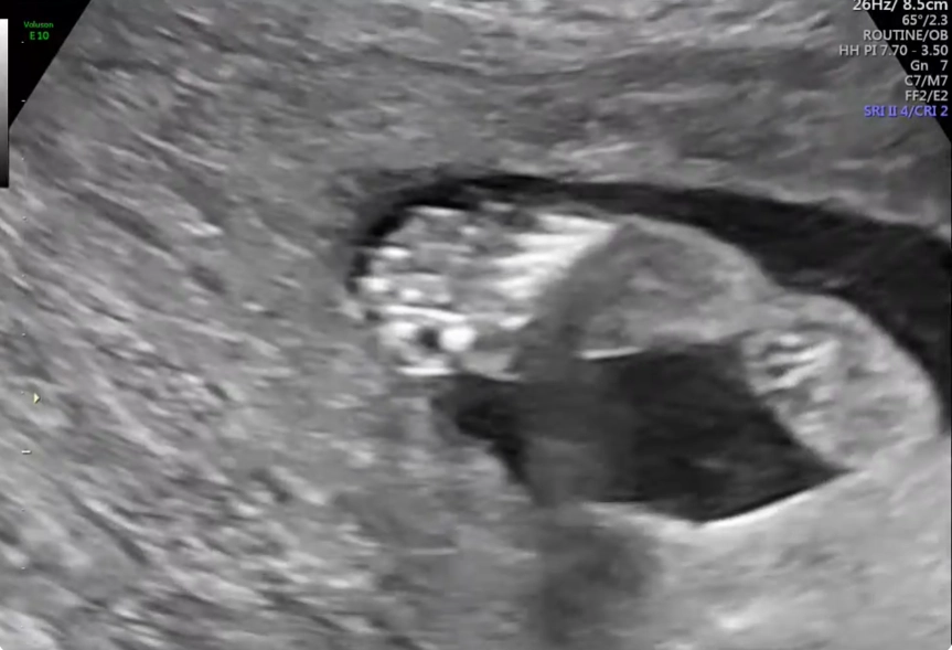 Bàn chân khoèo ở thai nhi (Clubfoot)