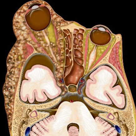 U sợi thần kinh (Neurofibroma)