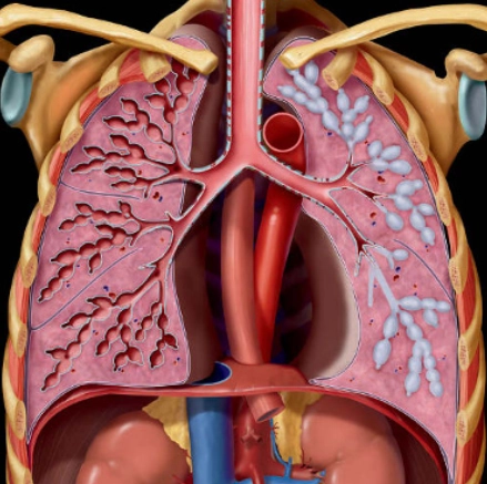 Hội chứng Williams-Campbell (Williams-Campbell Syndrome) 
