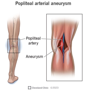 Phình động mạch khoeo (Popliteal artery aneurysm)