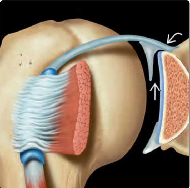 Rãnh dưới sụn viền trên (Superior sublabral sulcus)