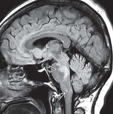 Viêm bạch huyết mạn tính với ngấm thuốc quanh mạch máu ở cầu não đáp ứng với steroid (CLIPPERS)