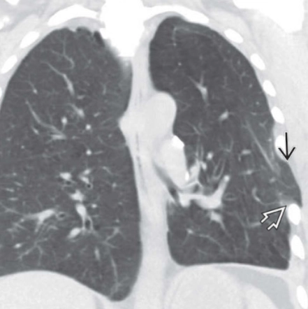 Thoát vị phổi (Lung Herniation)