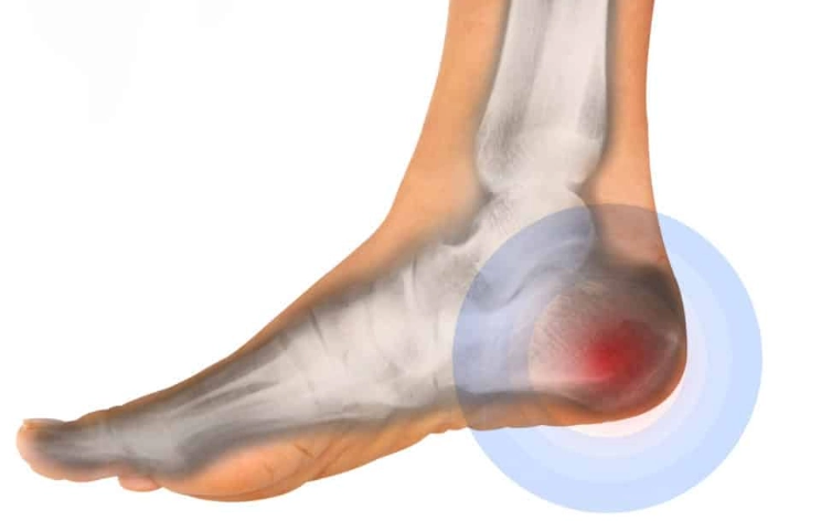 Gãy xương gót (Calcaneal fracture) 