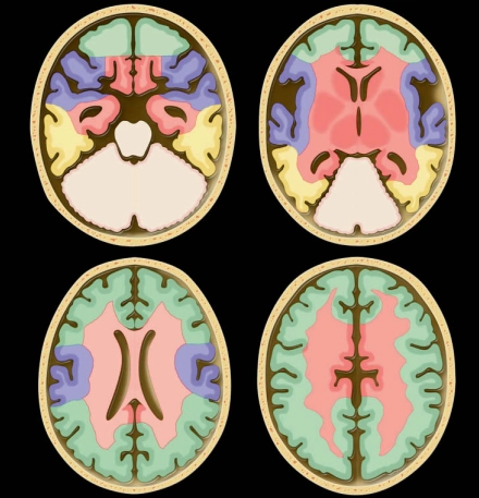 Huyết khối tĩnh mạch não sâu (Deep cerebral vein thrombosis)