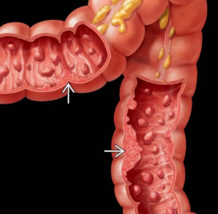 Hội chứng đa polyp tuyến gia đình (Familial Adenomatous Polyposis- FAP)