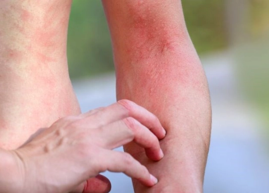 Bệnh tế bào mast (Mastocytosis)