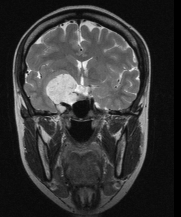 U mạch máu xoang hang (Cavernous Sinus Hemangioma)