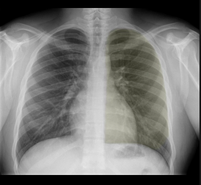 Xẹp thùy trên phổi trái  (Left upper lobe atelectasis)