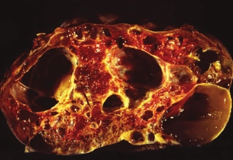 U mạch bạch huyết lách (Splenic lymphangioma)