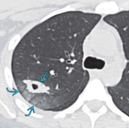Dấu hiệu quầng sáng (CT Halo Sign)