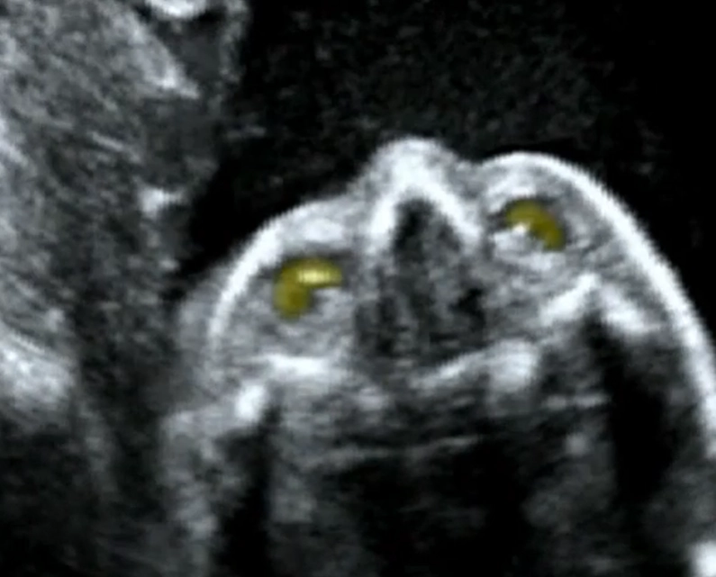 Tật mắt nhỏ và không có mắt ở thai (Microphthalmia and Anophthalmia)