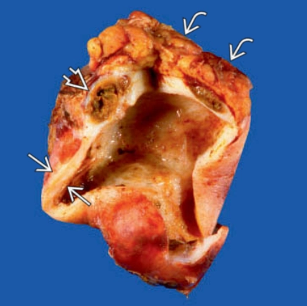 Viêm túi mật u hạt vàng (Xanthogranulomatous cholecystitis - XGC)