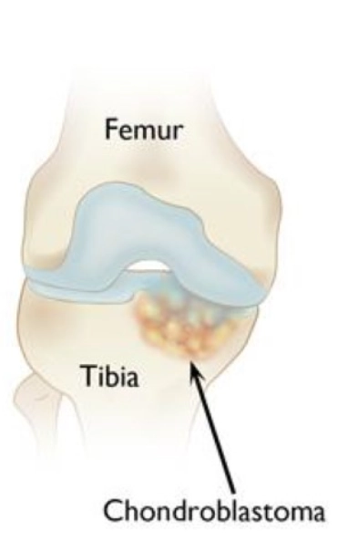  U nguyên bào sụn (Chondroblastoma)
