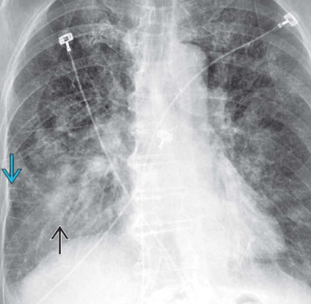 Dày vách liên tiểu thùy (Interlobular septal thickening) 