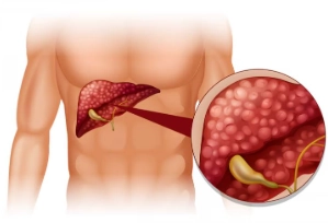 Tụ mủ túi mật (Gallbladder empyema)