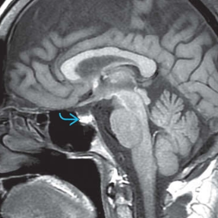  Bệnh não gan (Hepatic Encephalopathy- HE)