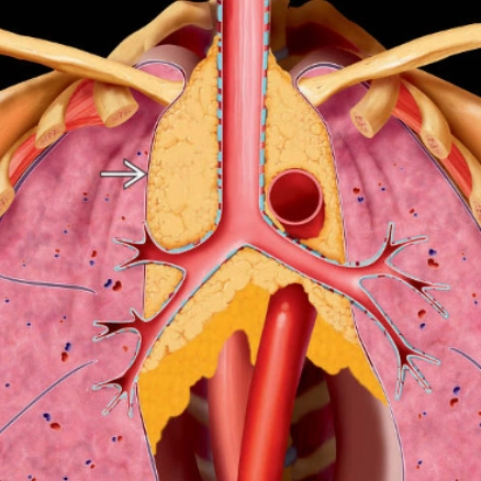 Bệnh nhiễm mỡ trung thất (Mediastinal Lipomatosis)