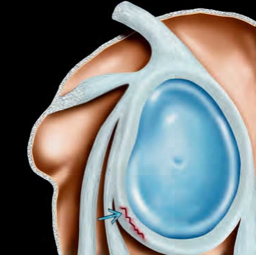 Tổn thương Perthes (Perthes lesion)