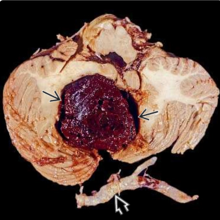 Xuất huyết nhu mô não (Intraparenchymal hemorrhage)