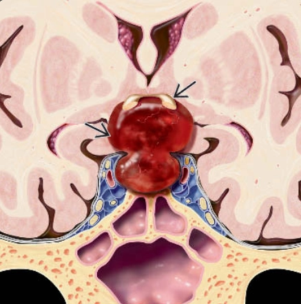 Đột quỵ tuyến yên (Pituitary apoplexy)