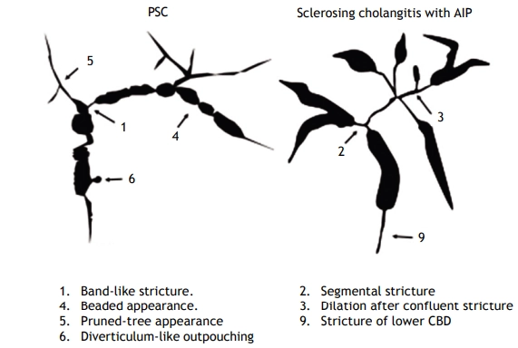 Viêm đường mật tự miễn (IgG4-related sclerosing cholangitis - IgG4-RSC)