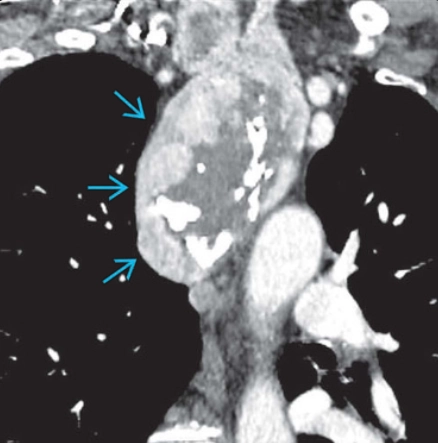 Dấu hiệu cổ-ngực (Cervicothoracic Sign)