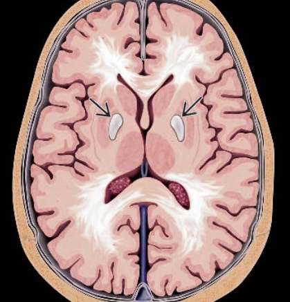 Ngộ độc Carbon Monoxide (Carbon Monoxide Poisoning)