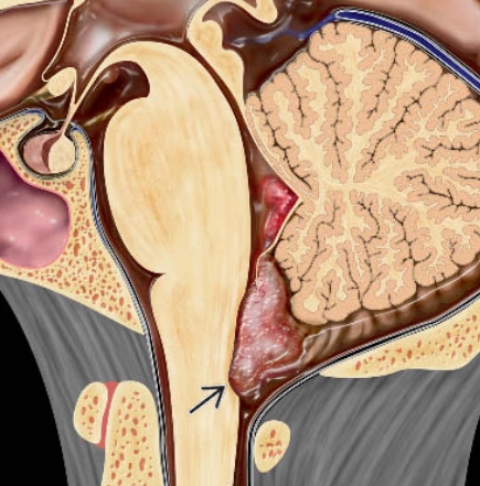 U dưới màng não thất (Subependymoma)