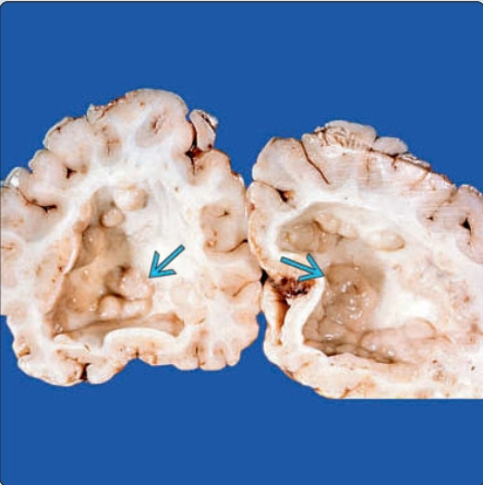 Lạc chỗ chất xám não thai nhi (Gray matter heterotopia)