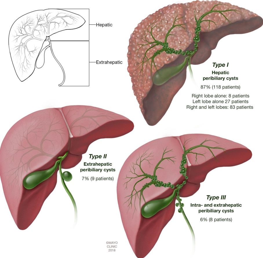 Nang quanh đường mật (Peribiliary cyst)