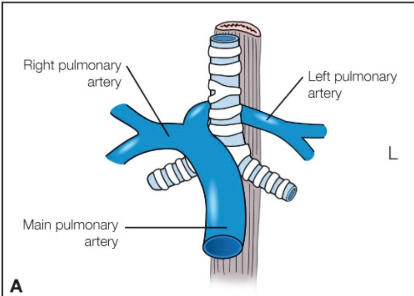 Vòng động mạch phổi (Pulmonary arterial sling)