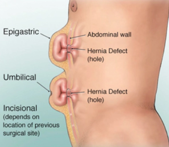 Thoát vị đường giữa bụng (Epigastric Hernia)