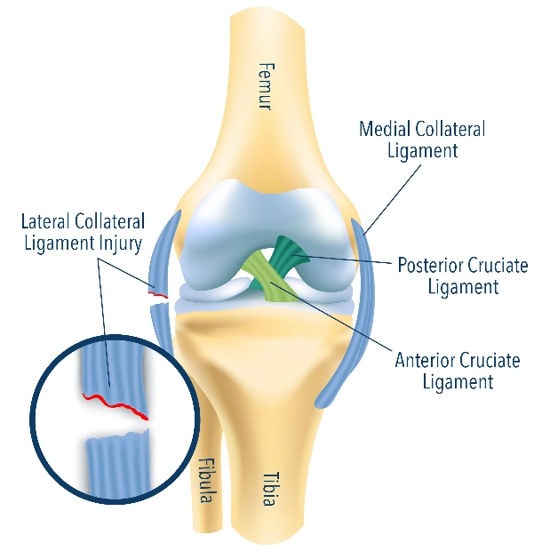 Tổn thương phức hợp dây chằng bên ngoài (Lateral Collateral Ligament - LCL complex)