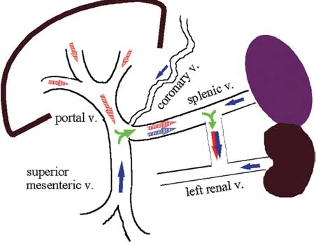 Shunt động- tĩnh mạch cửa trong gan (Intrahepatic arterioportal shunt)