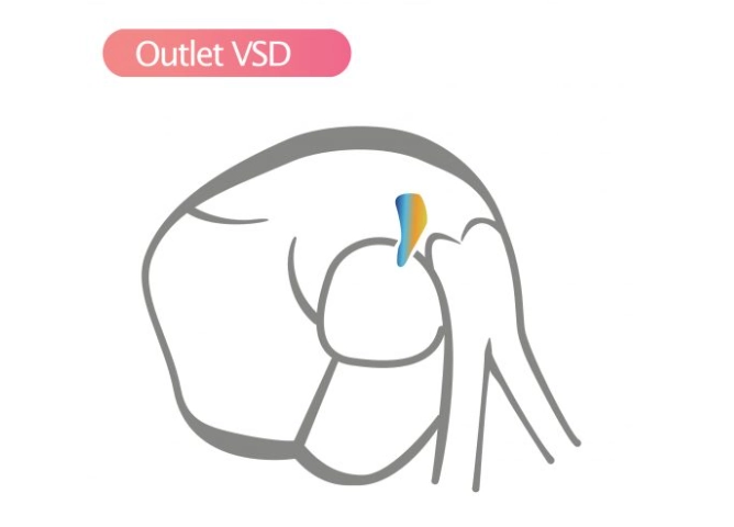 Thông liên thất phần thoát (Outlet VSD)