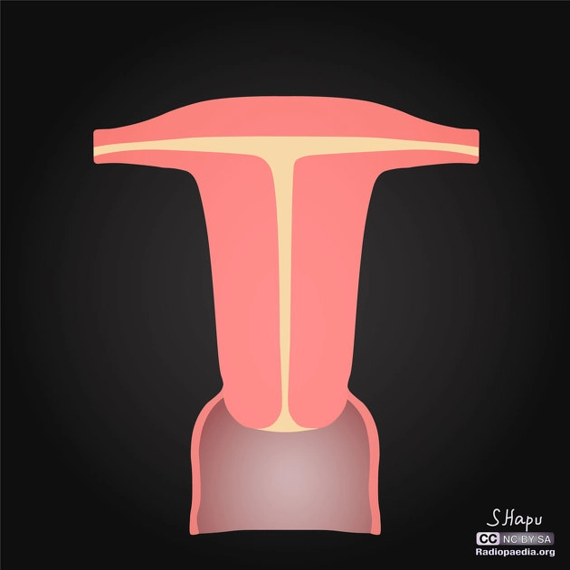 Tử cung hình chữ T (T-shaped uterus)