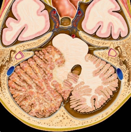 U tế bào hạch loạn sản tiểu não (Dysplastic Cerebellar Gangliocytoma)/Bệnh Lhermitte-Duclos (Lhermitte-Duclos Disease- LDD)