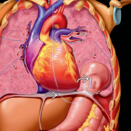 Vỡ cơ hoành (Diaphragmatic Rupture)