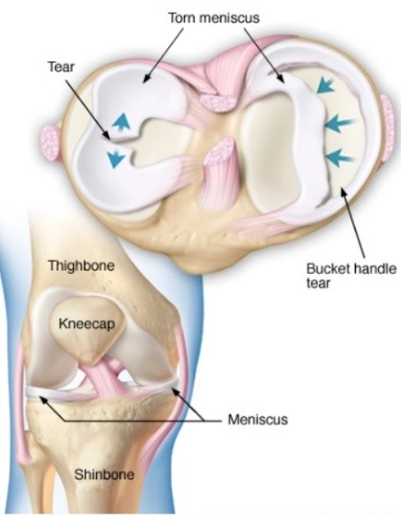 Rách sụn chêm kiểu quai xô (Bucket-handle meniscal tear)
