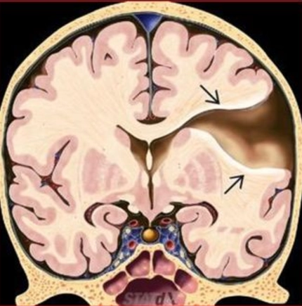 Nhuyễn não và rỗng não thai (Encephalomalacia và Porencephaly)