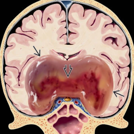 U sao bào dạng nhầy lông (Pilomyxoid Astrocytoma- PMA)