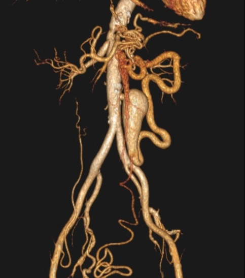 Phình động mạch mạc treo tràng dưới (Inferior Mesenteric Artery - IMA Aneurysm)