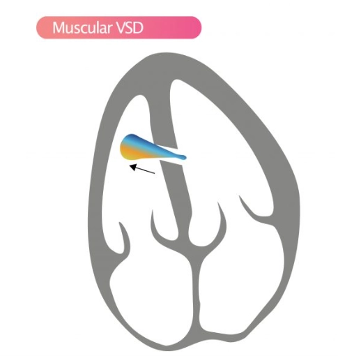 Thông liên thất phần cơ (Muscular VSD)