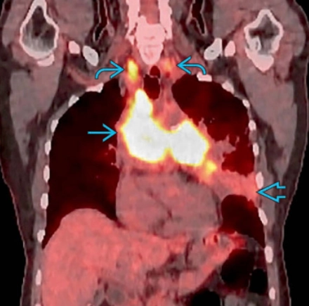 Bệnh phổi do xạ trị (Radiation-induced lung disease - RILD)