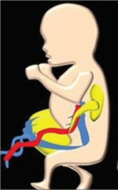 Lộn ổ nhớp và hội chứng OEIS thai quý I