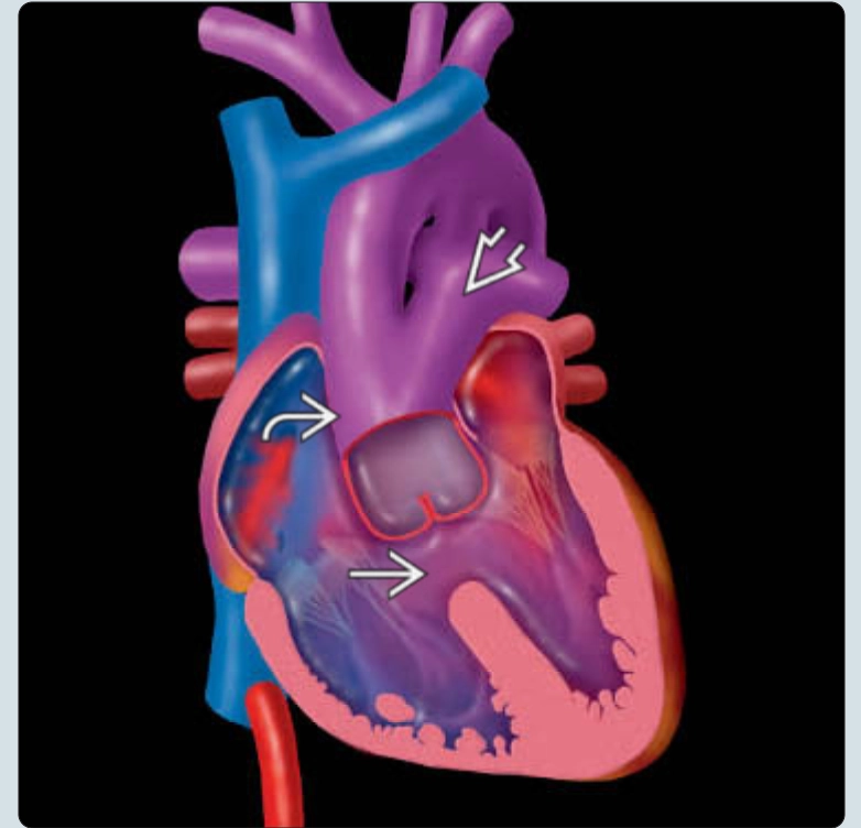 Thân chung động mạch